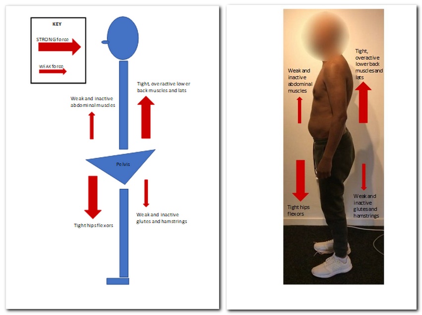 Schematic showing forward tilted pelvis and the imbalanced forces acting on it. Photo showing the same thing. How to alleviate your lower back pain? Reverse the imbalances.